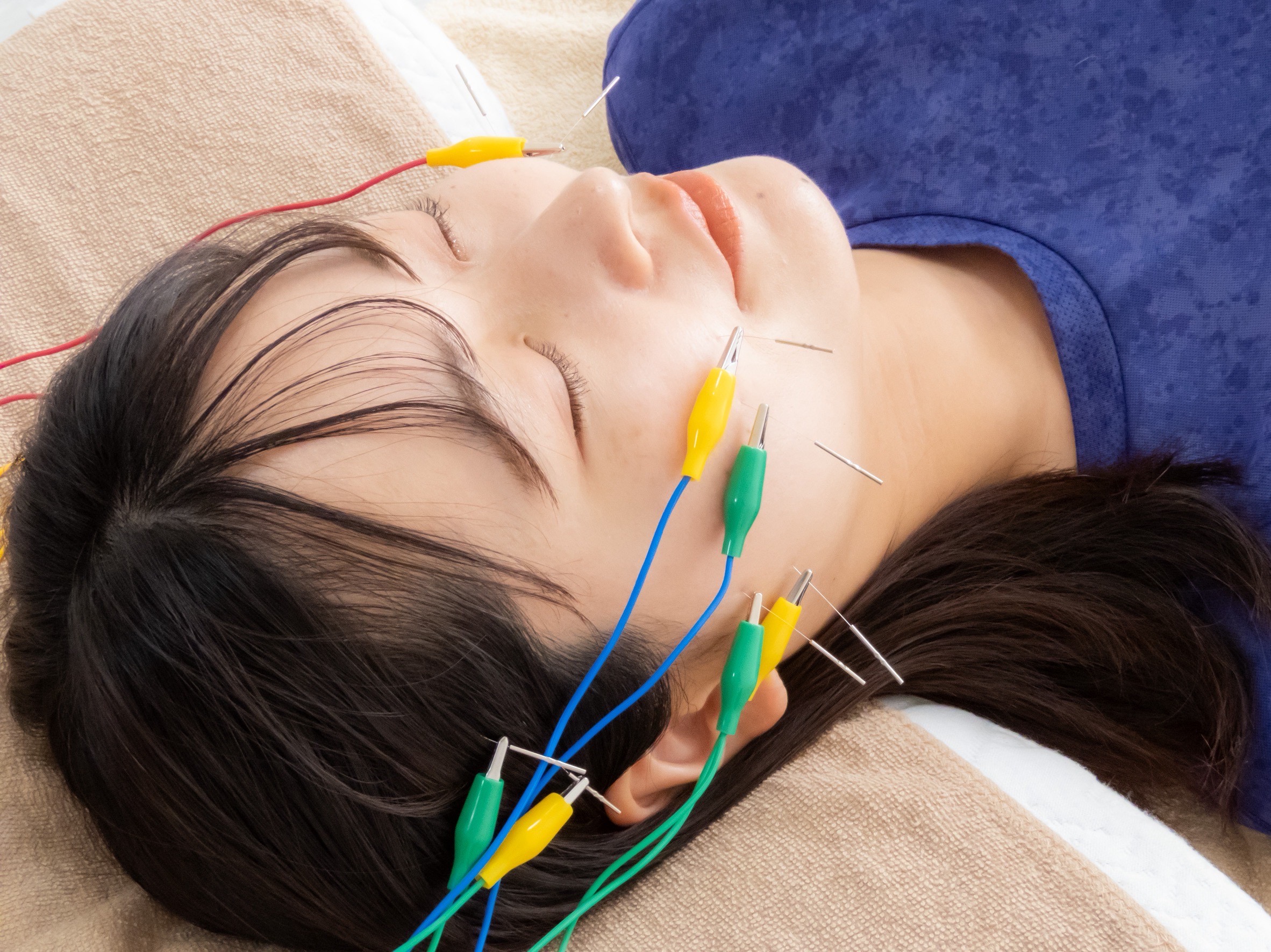 【美容医療はちょっと怖い…】そんなあなたにおすすめしたいMoveactの美容鍼