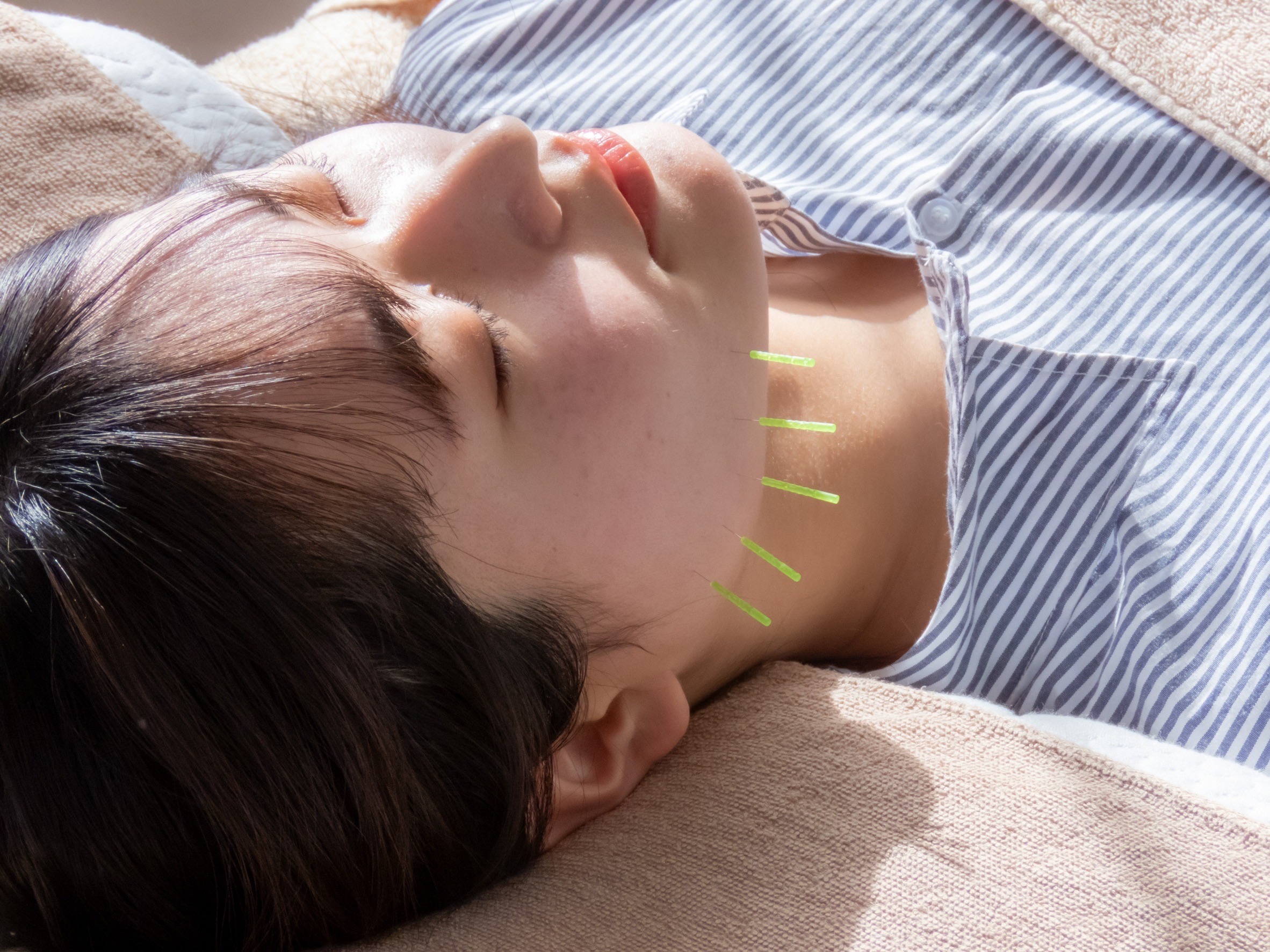 【イライラ・不調肌】美容鍼が“整える”鍵になる？