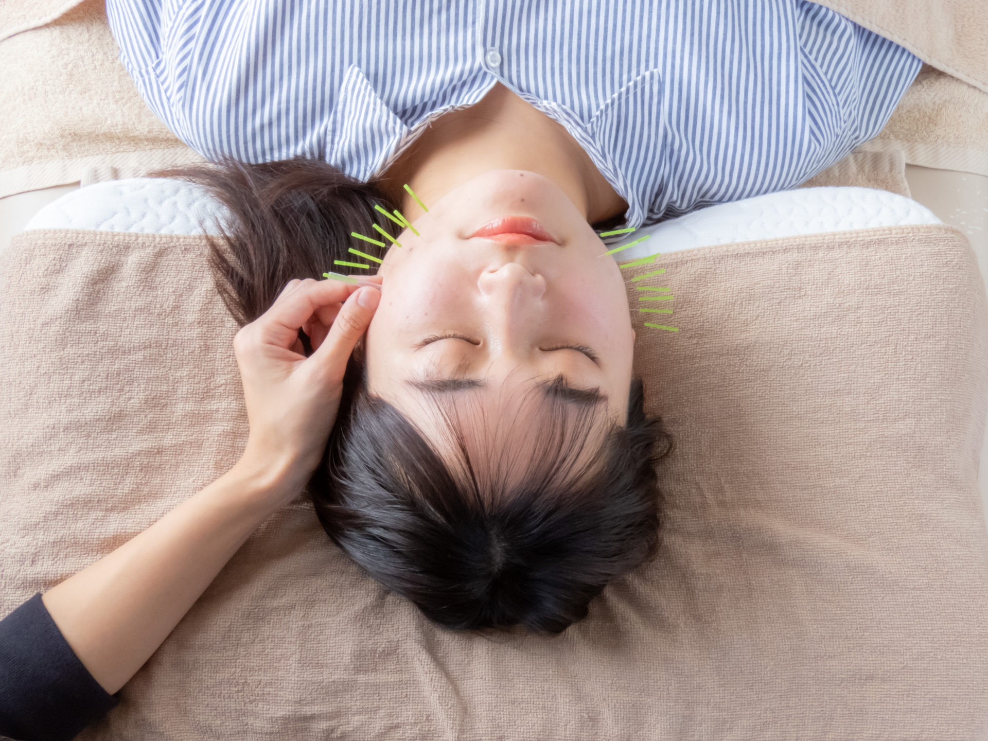 浅口市金光町で美容鍼!たるみに悩む方へ